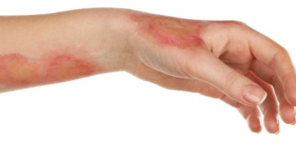 Various Types And Causes Of Skin Burns Flashcards